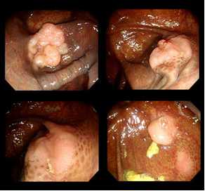 図1 大腸メラノーシス(腸の表面が黒くなる)