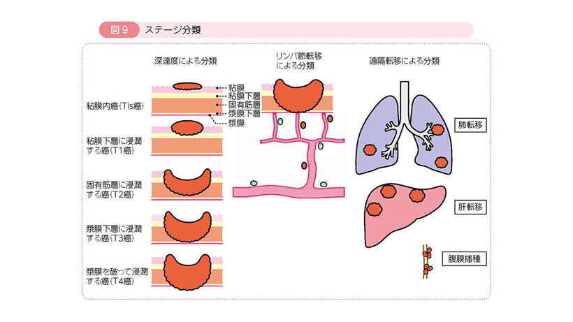 ステージの分類